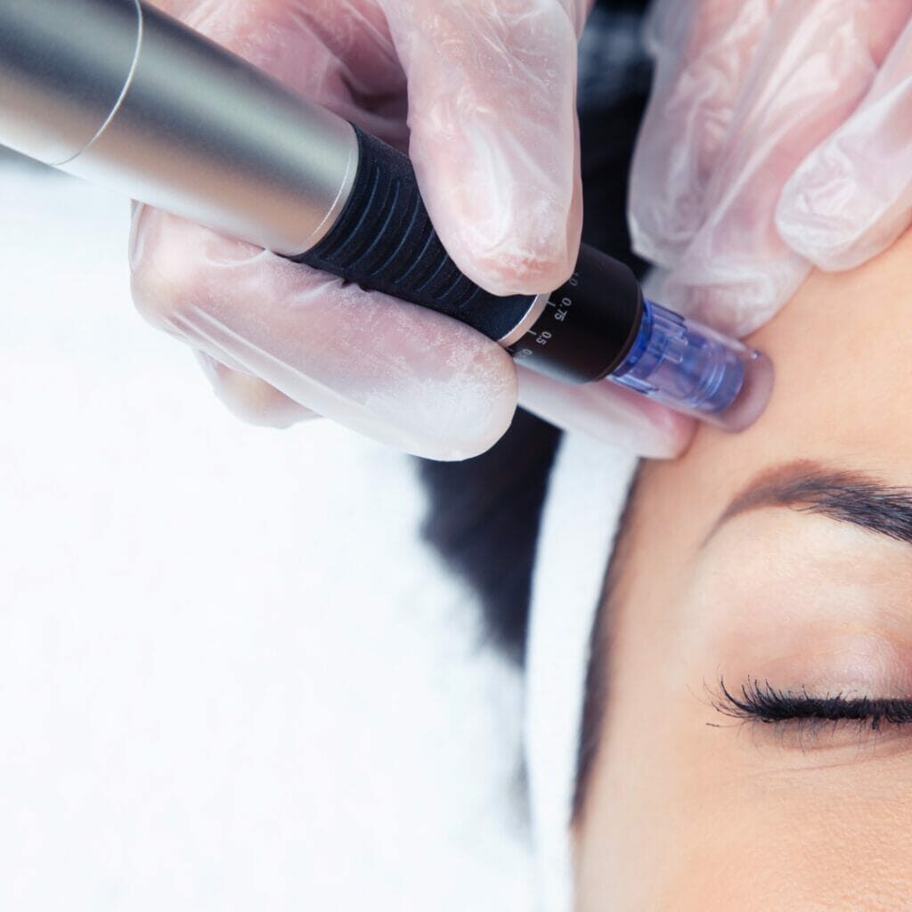 Female client with eyes closed receiving microneedling treatment. Services provided by Fabulously Beautiful, Sutton Valence, Kent