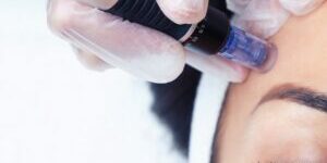 Female client with eyes closed receiving microneedling treatment. Services provided by Fabulously Beautiful, Sutton Valence, Kent